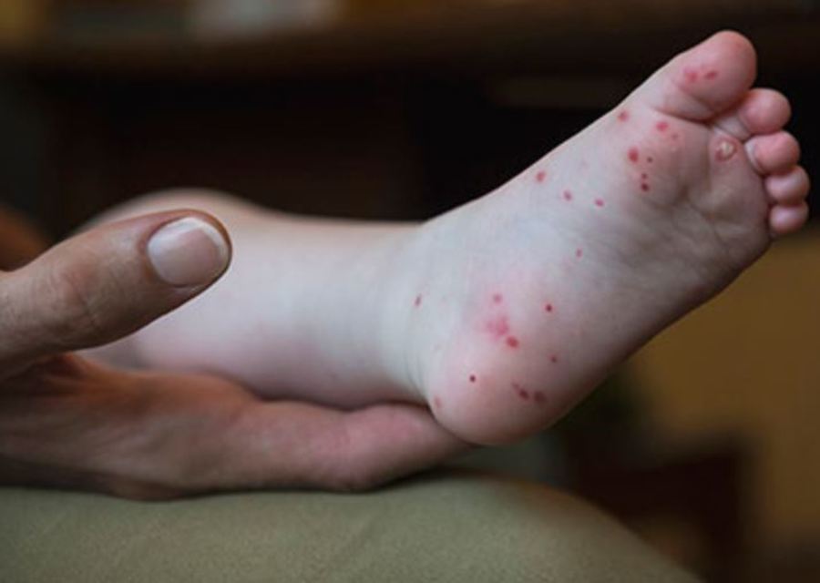 Madison-Grant schools closed Friday after students test positive for hand, foot,...